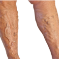 varicose_veins-2