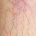 varicose_veins-3